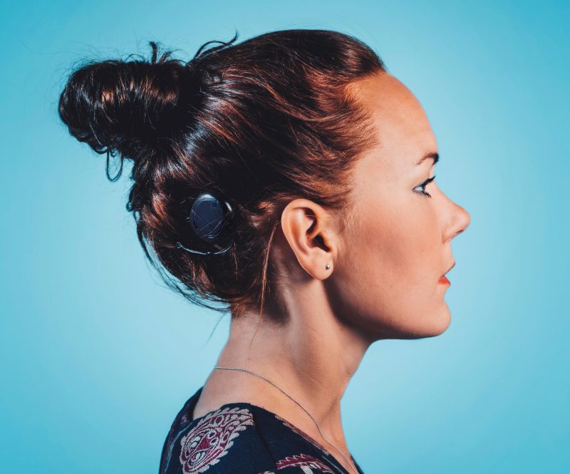 Kvinnas huvud i profil, som har ett cochleaimplmantat.